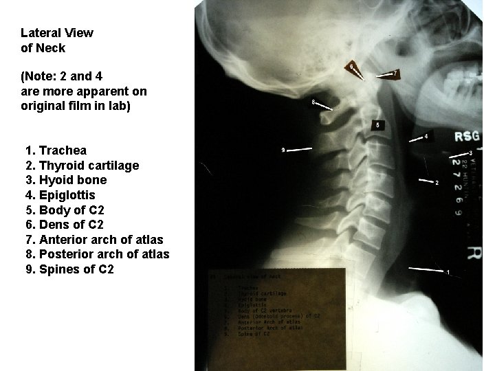 Lateral View of Neck (Note: 2 and 4 are more apparent on original film