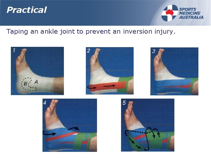 Practical Taping an ankle joint to prevent an inversion injury. 