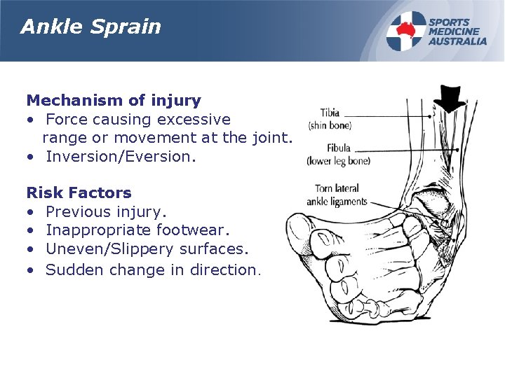 Ankle Sprain Mechanism of injury • Force causing excessive range or movement at the