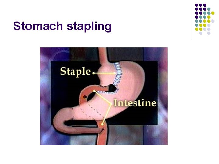 Stomach stapling 