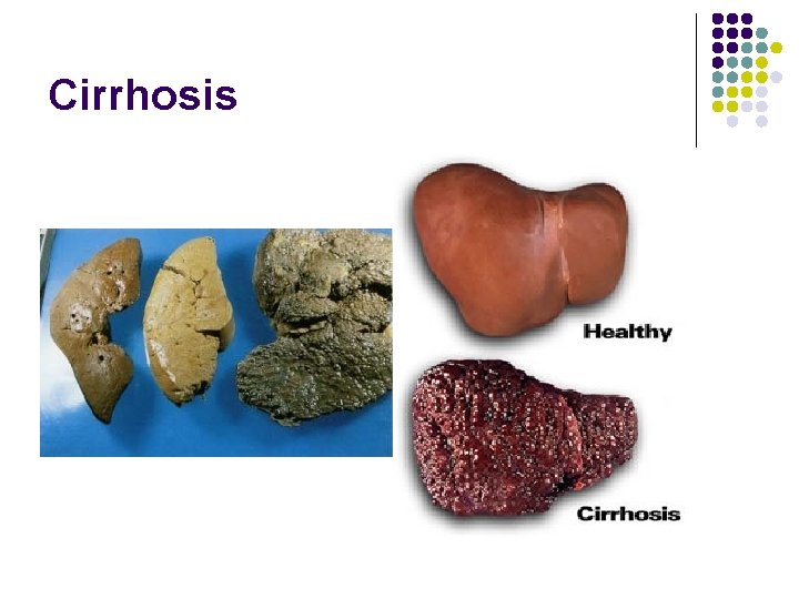 Cirrhosis Cirrhosis