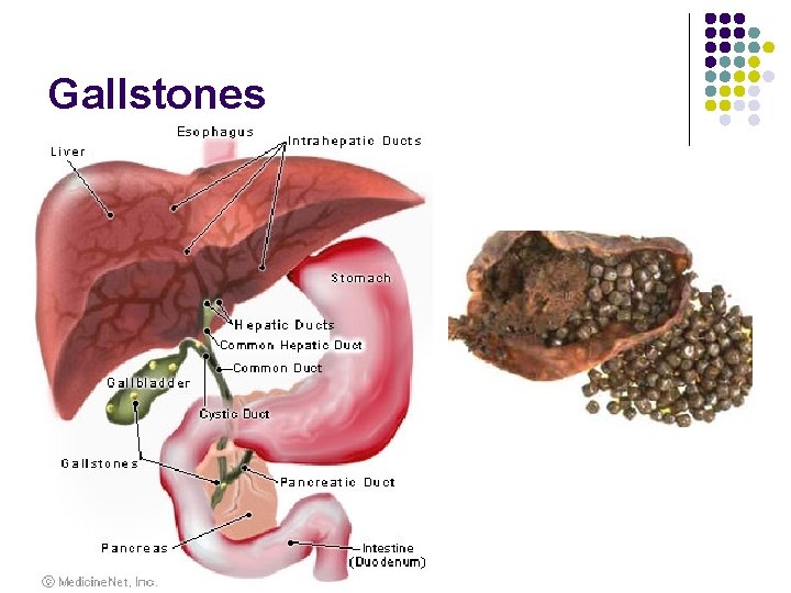 Gallstones Gallstones