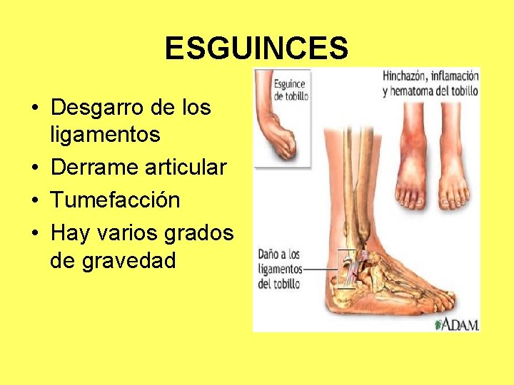 ESGUINCES • Desgarro de los ligamentos • Derrame articular • Tumefacción • Hay varios