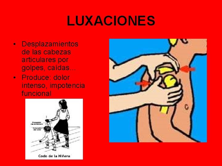 LUXACIONES • Desplazamientos de las cabezas articulares por golpes, caídas… • Produce: dolor intenso,