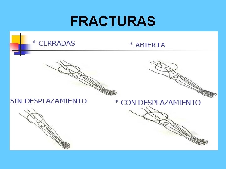 FRACTURAS 