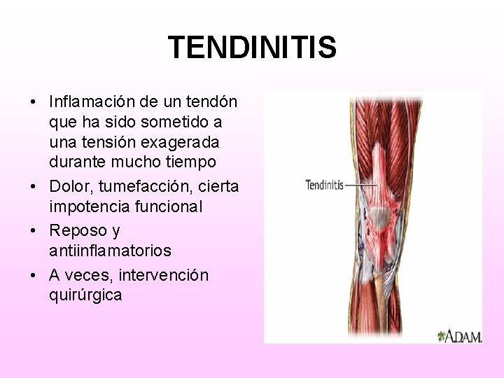 TENDINITIS • Inflamación de un tendón que ha sido sometido a una tensión exagerada