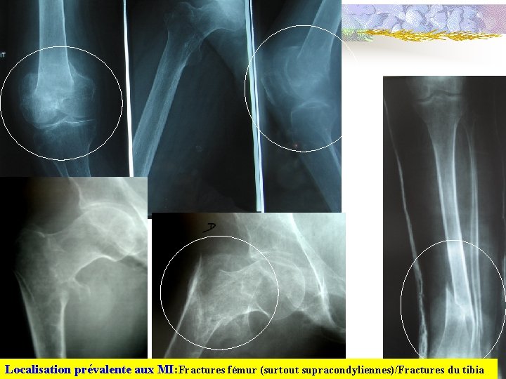 Localisation prévalente aux MI: Fractures fémur (surtout supracondyliennes)/Fractures du tibia 