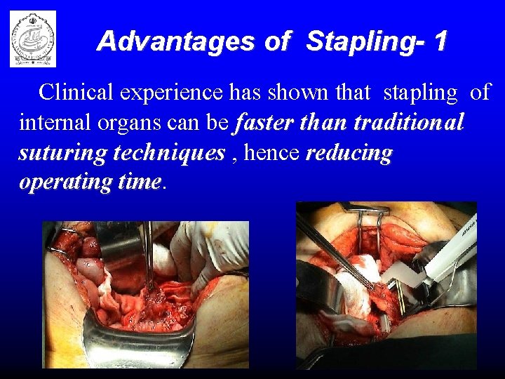 Advantages of Stapling- 1 Clinical experience has shown that stapling of internal organs can