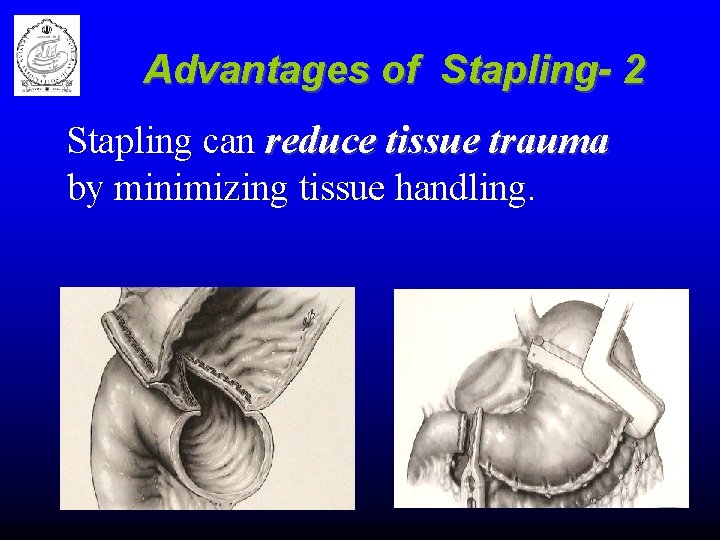 Advantages of Stapling- 2 Stapling can reduce tissue trauma by minimizing tissue handling. 