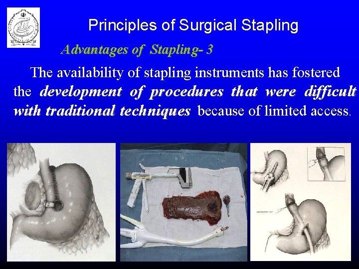 Principles of Surgical Stapling Advantages of Stapling- 3 The availability of stapling instruments has