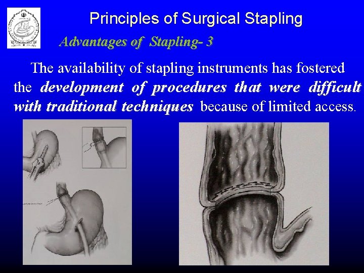 Principles of Surgical Stapling Advantages of Stapling- 3 The availability of stapling instruments has