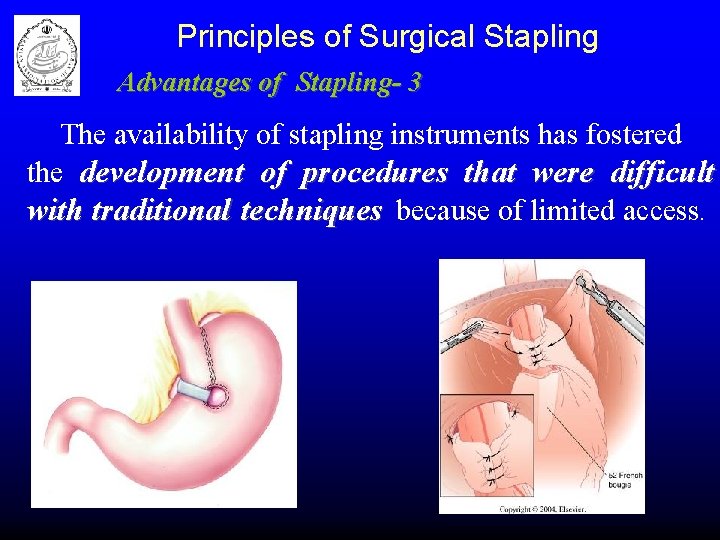 Principles of Surgical Stapling Advantages of Stapling- 3 The availability of stapling instruments has