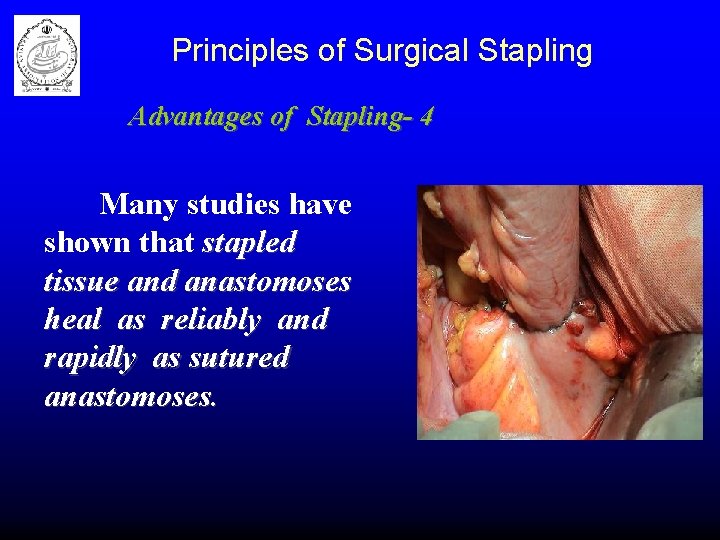 Principles of Surgical Stapling Advantages of Stapling- 4 Many studies have shown that stapled