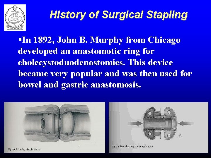 History of Surgical Stapling §In 1892, John B. Murphy from Chicago developed an anastomotic