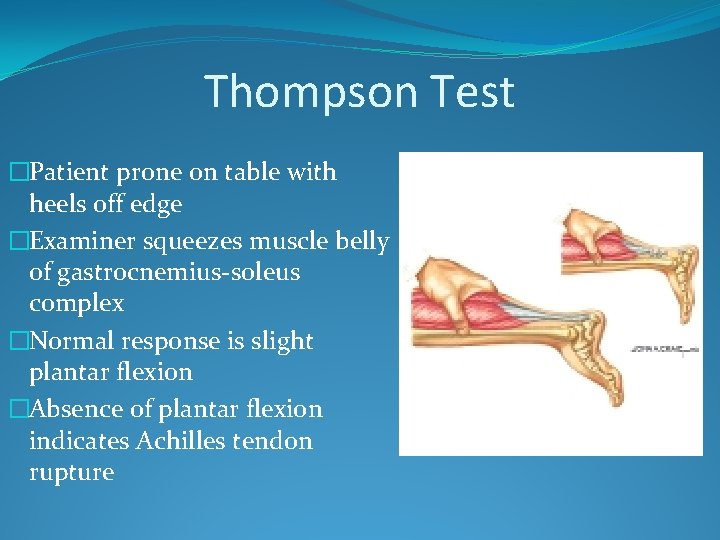 Thompson Test �Patient prone on table with heels off edge �Examiner squeezes muscle belly