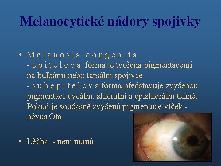 Melanocytické nádory spojivky • Melanosis congenita - e p i t e l o