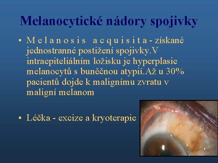 Melanocytické nádory spojivky • M e l a n o s i s a