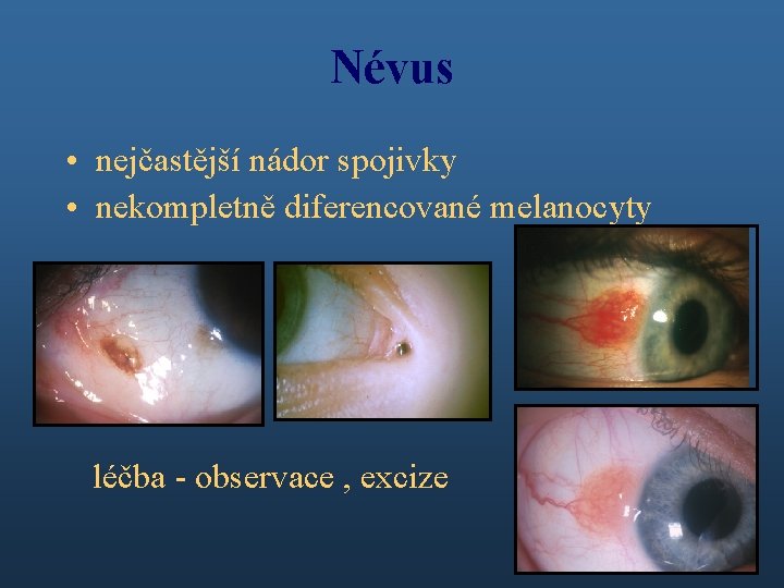 Névus • nejčastější nádor spojivky • nekompletně diferencované melanocyty léčba - observace , excize