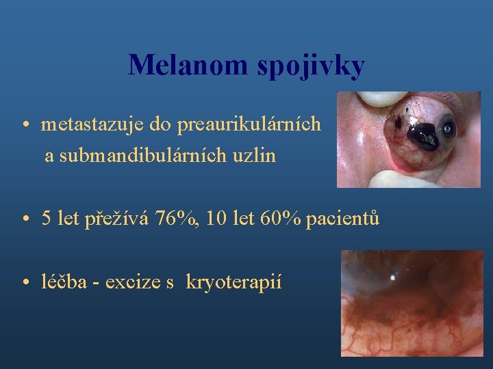 Melanom spojivky • metastazuje do preaurikulárních a submandibulárních uzlin • 5 let přežívá 76%,