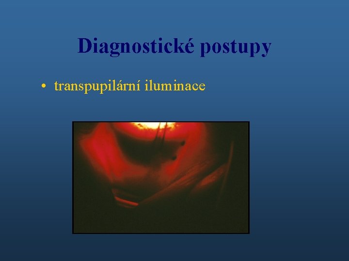 Diagnostické postupy • transpupilární iluminace 