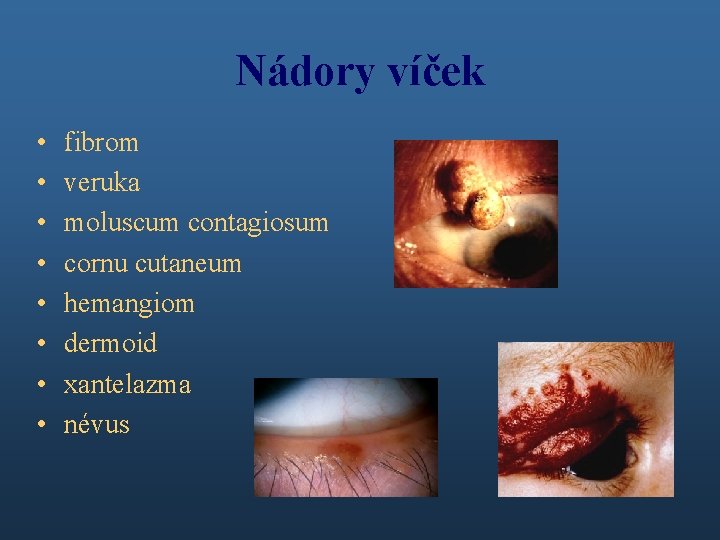 Nádory víček • • fibrom veruka moluscum contagiosum cornu cutaneum hemangiom dermoid xantelazma névus