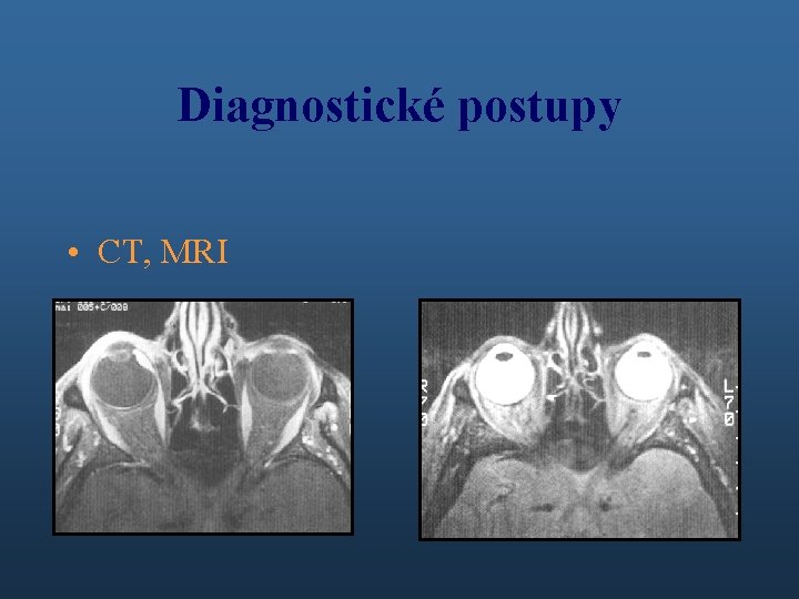 Diagnostické postupy • CT, MRI 