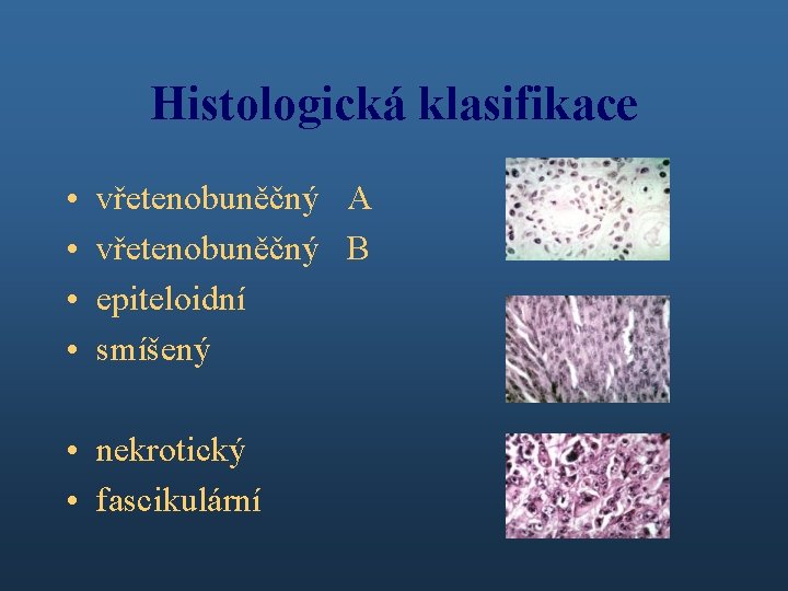 Histologická klasifikace • • vřetenobuněčný A vřetenobuněčný B epiteloidní smíšený • nekrotický • fascikulární