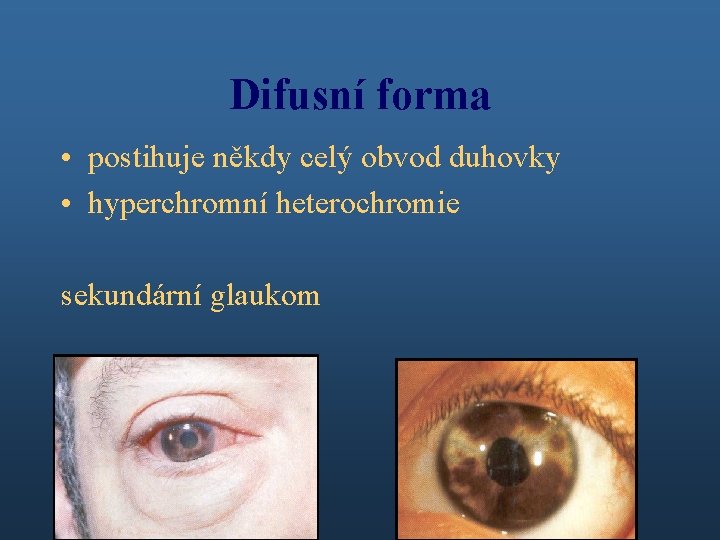 Difusní forma • postihuje někdy celý obvod duhovky • hyperchromní heterochromie sekundární glaukom 