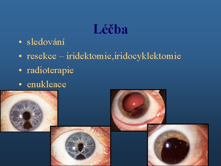  • • Léčba sledování resekce – iridektomie, iridocyklektomie radioterapie enukleace 