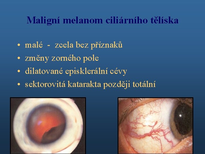 Maligní melanom ciliárního tělíska • • malé - zcela bez příznaků změny zorného pole