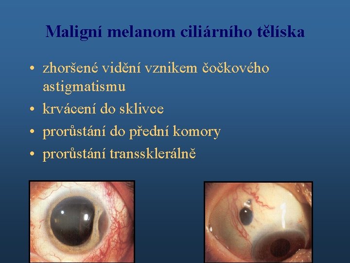 Maligní melanom ciliárního tělíska • zhoršené vidění vznikem čočkového astigmatismu • krvácení do sklivce