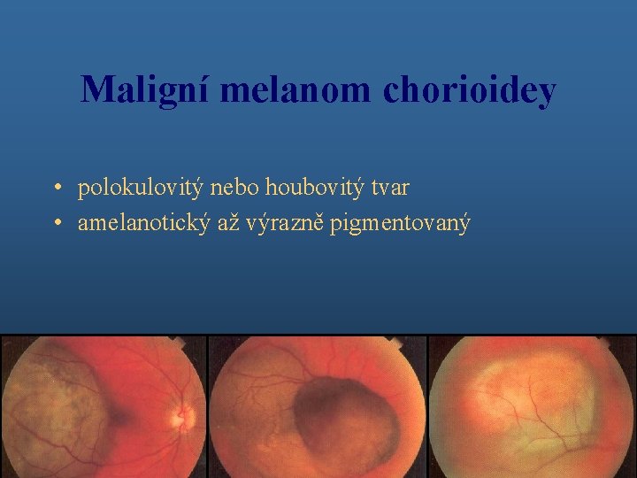 Maligní melanom chorioidey • polokulovitý nebo houbovitý tvar • amelanotický až výrazně pigmentovaný 