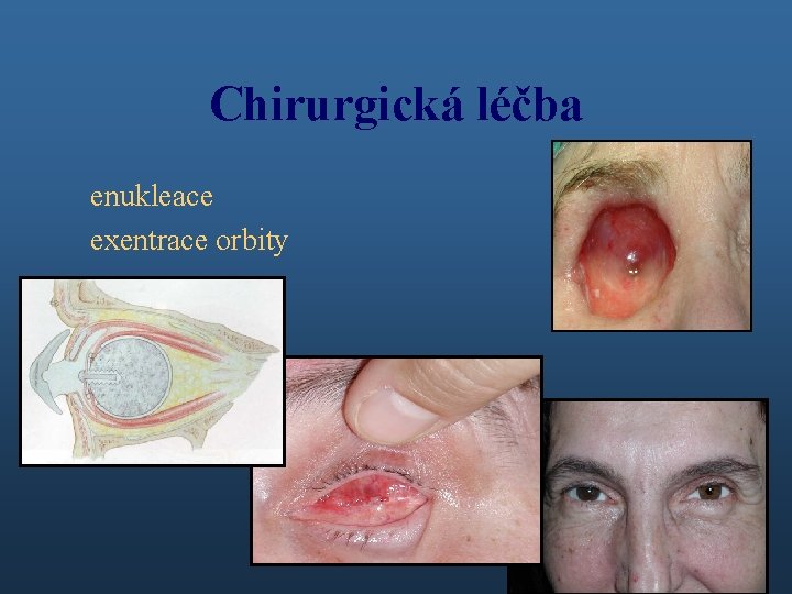 Chirurgická léčba enukleace exentrace orbity 