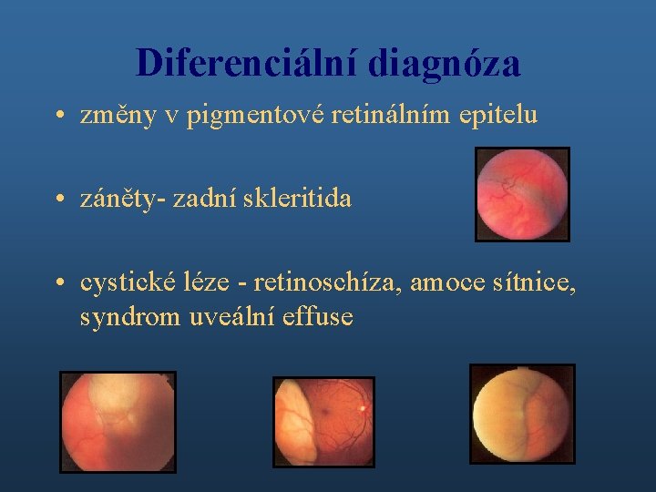 Diferenciální diagnóza • změny v pigmentové retinálním epitelu • záněty- zadní skleritida • cystické