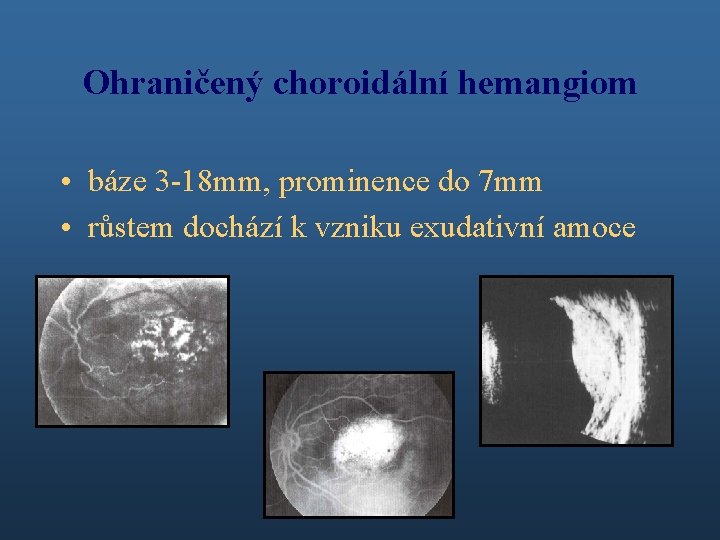 Ohraničený choroidální hemangiom • báze 3 -18 mm, prominence do 7 mm • růstem