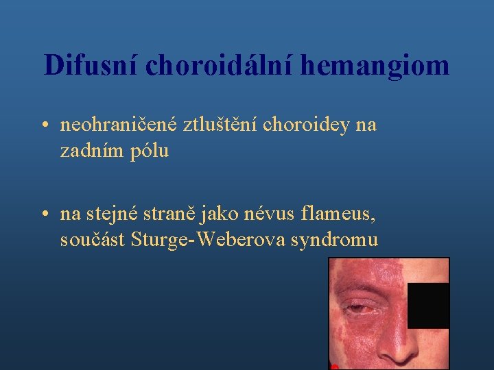 Difusní choroidální hemangiom • neohraničené ztluštění choroidey na zadním pólu • na stejné straně