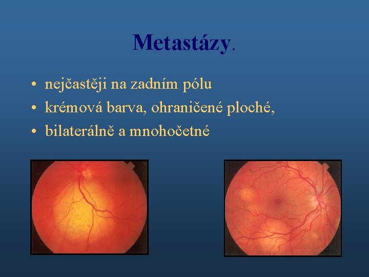 Metastázy. • nejčastěji na zadním pólu • krémová barva, ohraničené ploché, • bilaterálně a