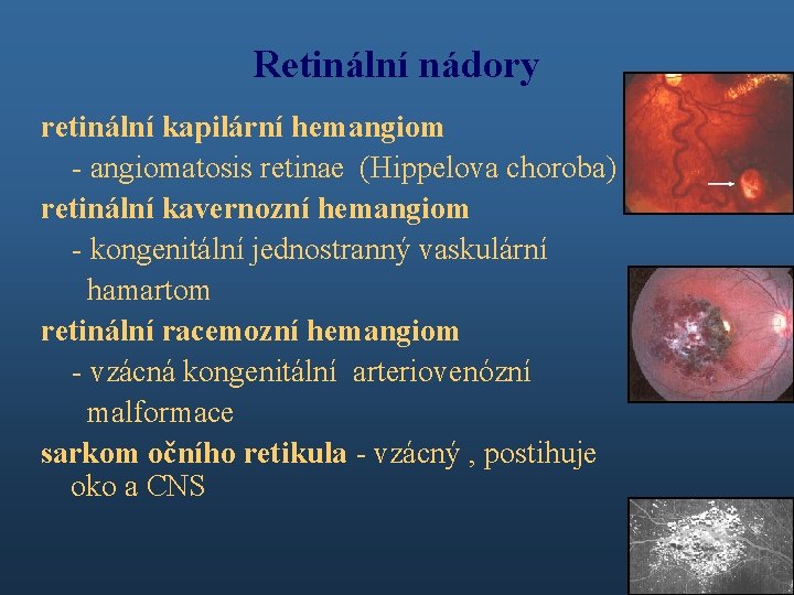 Retinální nádory retinální kapilární hemangiom - angiomatosis retinae (Hippelova choroba) retinální kavernozní hemangiom -