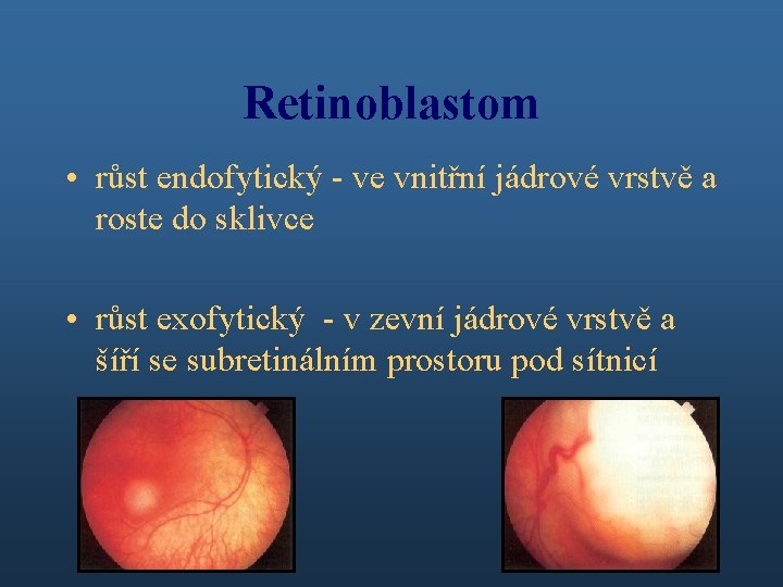 Retinoblastom • růst endofytický - ve vnitřní jádrové vrstvě a roste do sklivce •