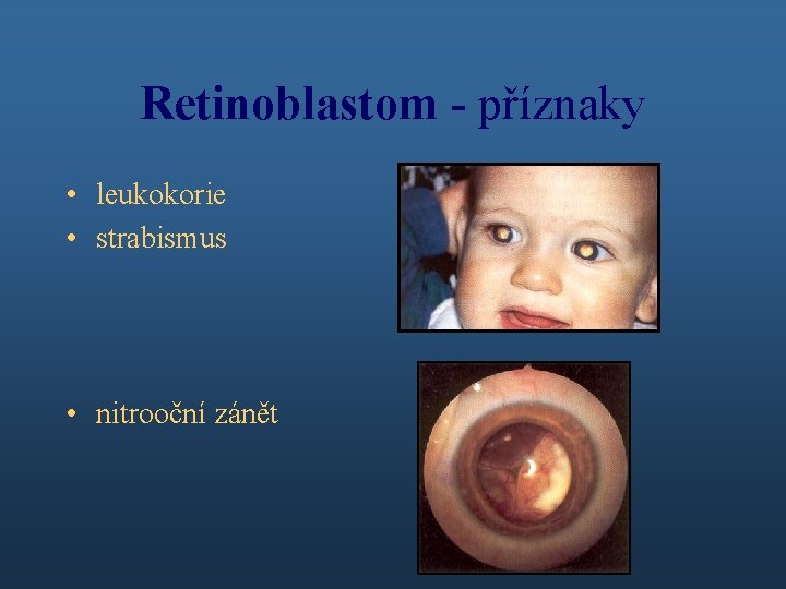 Retinoblastom - příznaky • leukokorie • strabismus • nitrooční zánět 