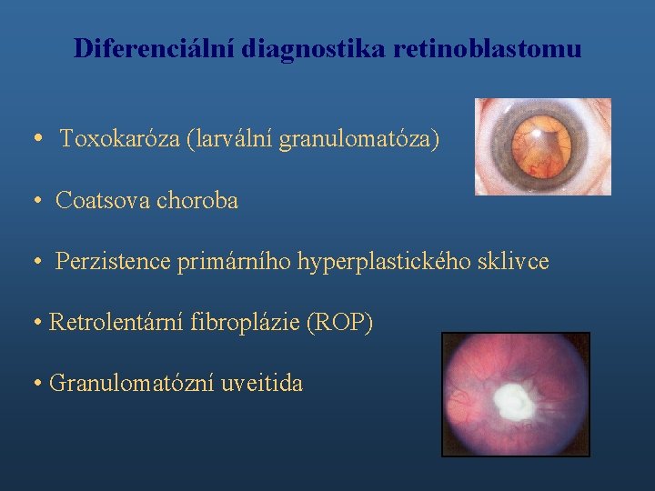 Diferenciální diagnostika retinoblastomu • Toxokaróza (larvální granulomatóza) • Coatsova choroba • Perzistence primárního hyperplastického