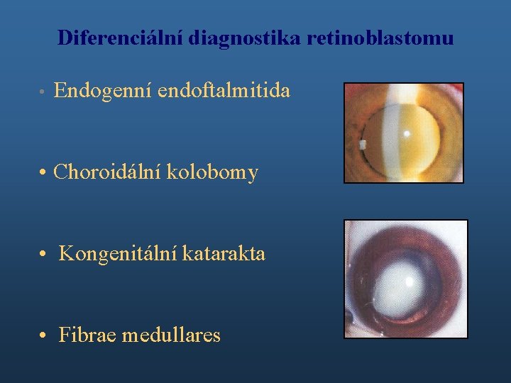 Diferenciální diagnostika retinoblastomu • Endogenní endoftalmitida • Choroidální kolobomy • Kongenitální katarakta • Fibrae