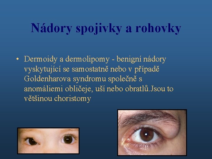 Nádory spojivky a rohovky • Dermoidy a dermolipomy - benigní nádory vyskytující se samostatně