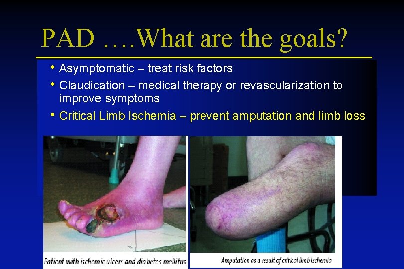 PAD …. What are the goals? • Asymptomatic – treat risk factors • Claudication