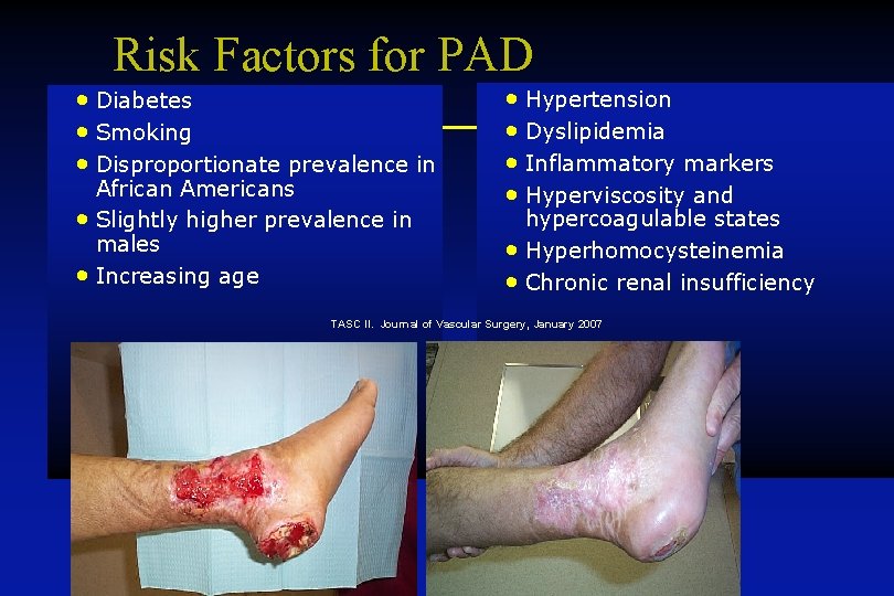 Risk Factors for PAD • Diabetes • Smoking • Disproportionate prevalence in African Americans