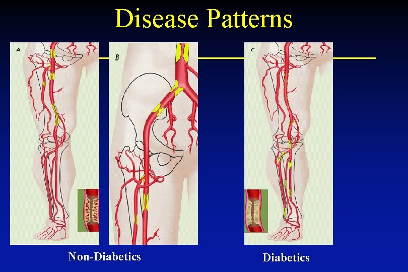 Disease Patterns Non-Diabetics 