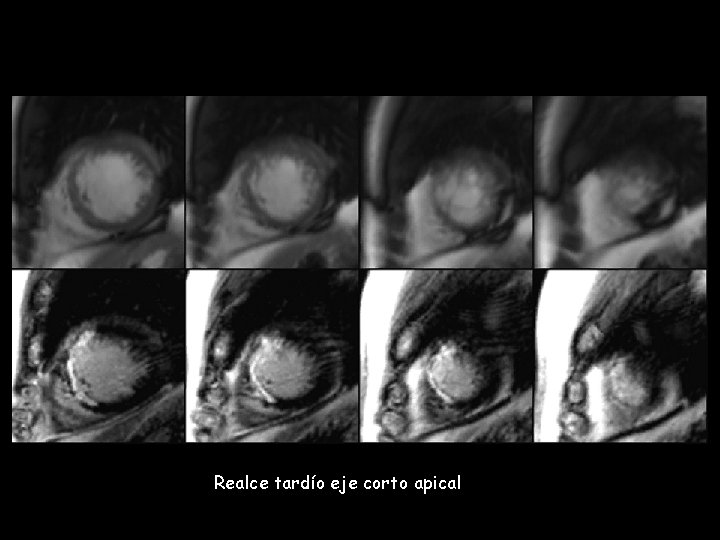 Realce tardío eje corto apical 