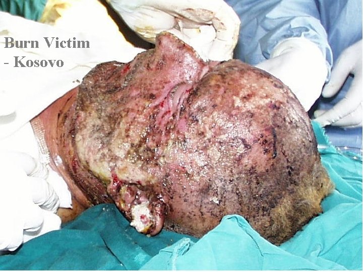 Burn Victim - Kosovo 