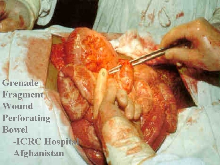 Grenade Fragment Wound – Perforating Bowel -ICRC Hospital Afghanistan 