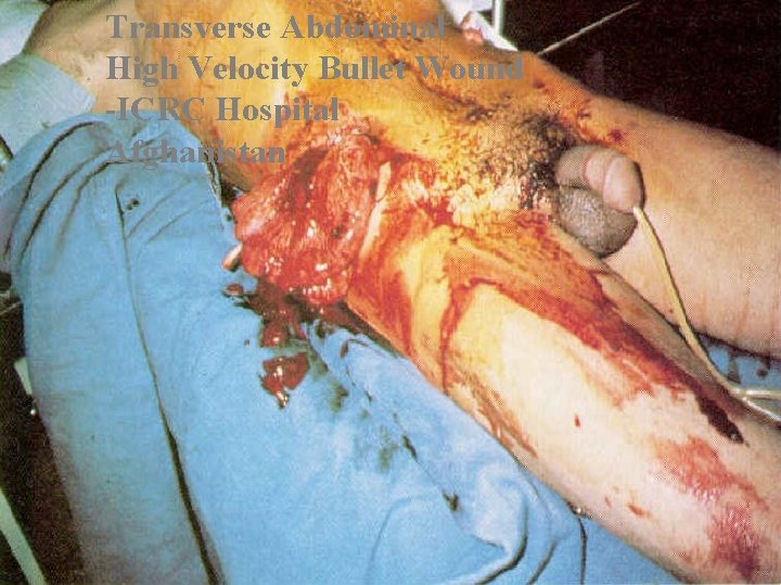 Transverse Abdominal High Velocity Bullet Wound -ICRC Hospital Afghanistan 